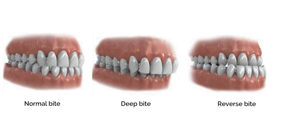 An incorrect bite can affect your dental health?
